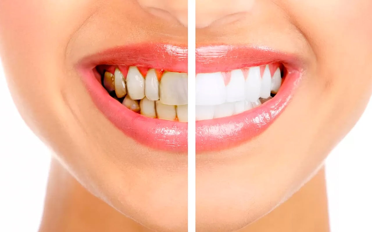 Diş Taşı – Tartar Nedir?
