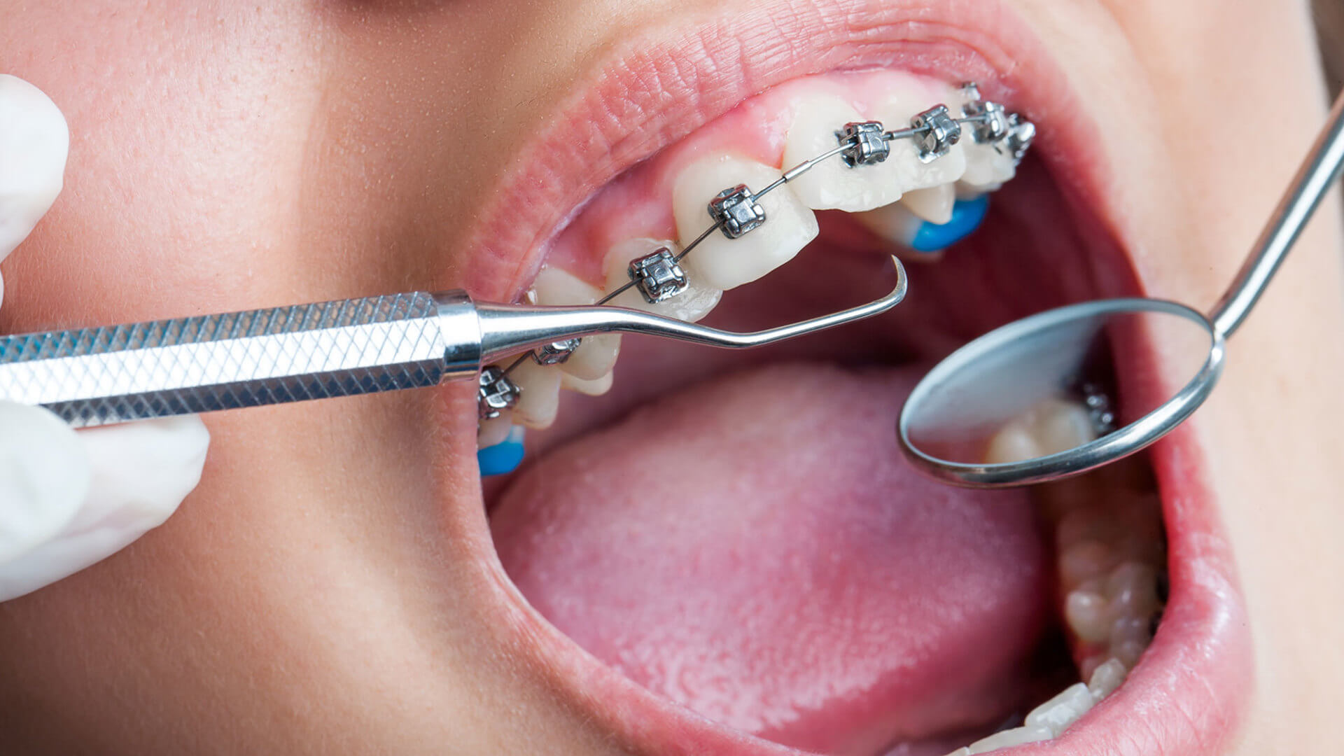 Periodontoloji Nedir?